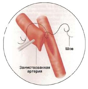 Operație by-pass aortocoronară