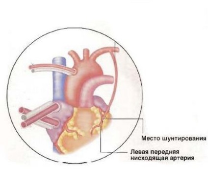 Operație by-pass aortocoronară