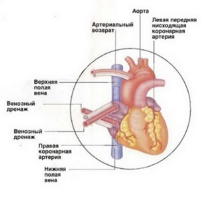 Operație by-pass aortocoronară