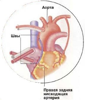 Operație by-pass aortocoronară