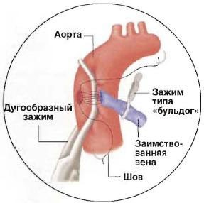 Operație by-pass aortocoronară