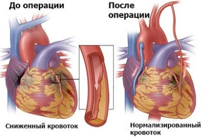 Avansarea aortocoronară face rudenko av
