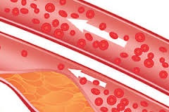 Stenozele aterosclerotice ale arterelor carotide ca cauză a accidentului cerebral