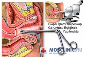 Biopsia cervicală ca biopsie, complicații