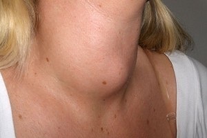 Boli ale glandei tiroide (sănătate feminină)