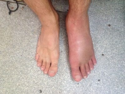 Fájó láb a láb járás közben és nyugalmi (az oldalon, a közepén) az oka annak, hogy ezt