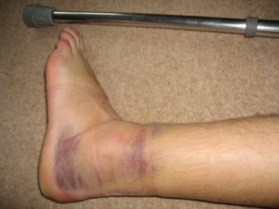 Piciorul în câmpul unui picior doare la mers și în repaus (în lateral, în mijloc) motivele pentru a face