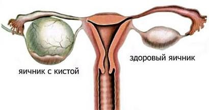 Partea dreaptă doare în timpul sarcinii norma sau patologia