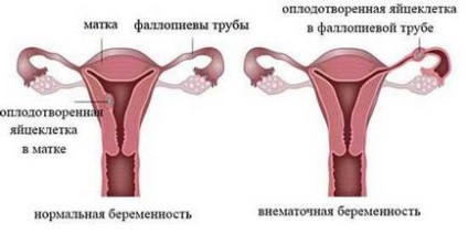 Болить правий бік при вагітності норма або патологія