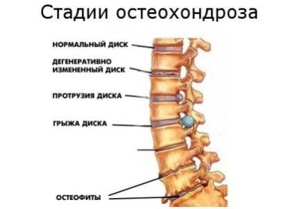 Fájdalom a háti gerinc okok és a kezelés