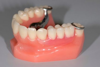 Recenzii Bugelnye dentures, preturi, rezultate foto