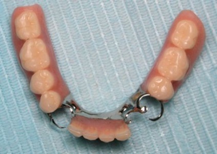 Recenzii Bugelnye dentures, preturi, rezultate foto