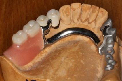 Бюгельні зубні протези відгуки, ціна, фото результату