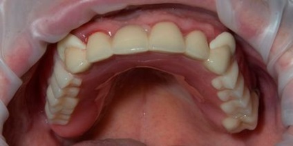 Recenzii Bugelnye dentures, preturi, rezultate foto