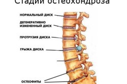 Ce este osteochondroza cervicală periculoasă