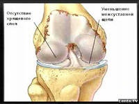 деформують артрозоартрити