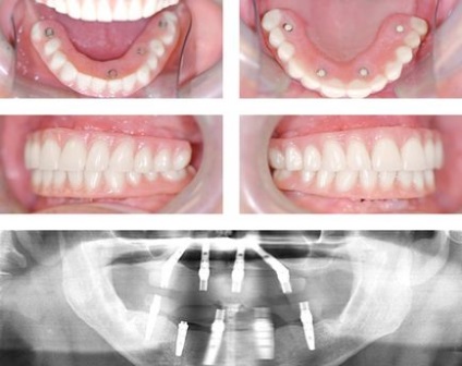 Implanturi dentare