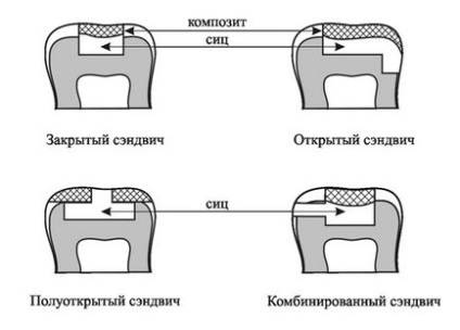 Dental-revue, статті, терапевтична, сучасні аспекти сендвіч-технології