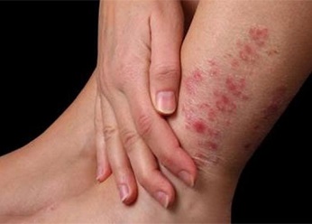 Dermatita pe picioare, cum se trateaza dermatita atopica pe picioare, picioare si coapse la adulti