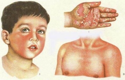A gyermekkori betegségek, veszélyes felnőtteknek