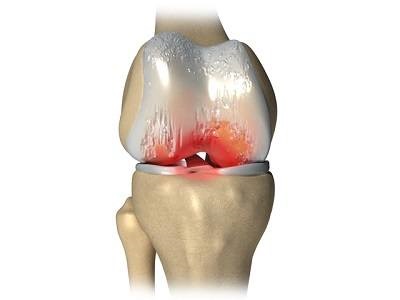 Дипроспан при артрозі колінного суглоба
