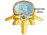 Дорсопатии попереково-крижового, шийного і грудного відділів хребта