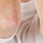 Eczemă pe simptomele feței, tratament, unguente, eczeme
