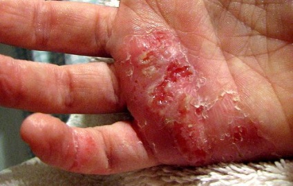 Eczemă pe mâini decât pentru a trata, droguri, recenzii
