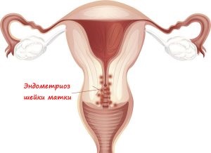 Endometrioza simptomelor cervixului, cauze, metode de tratament