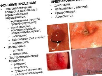 Epidermiziruyuschiysya endocervicosis - válaszokat és tanácsokat a kérdéseire választ domotvetov