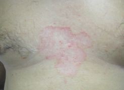 Micoza epidermodermică a pielii în practica unui dermatolog, # 05