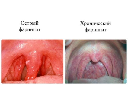 Torokgyulladás gyermekeknél a tünetek és a kezelés, megelőző intézkedések