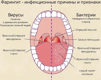 Фарингіт у дітей симптоми і лікування, профілактичні заходи