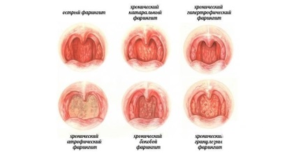 Фарингіт у дітей симптоми і лікування, профілактичні заходи