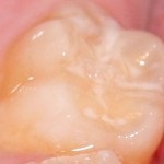 Фторування зубів у дітей