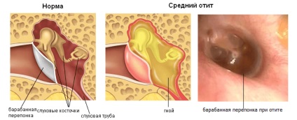 Furacilin alcool în urechea copiilor - instrucțiuni de utilizare, pot picura