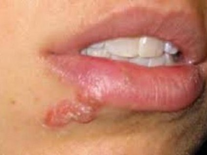Herpes az arcon a fényképet, okok és a tünetek, kezelési módszerek (ok) Herpes az arcon fotó, az okok és a tünetek, kezelési módszerek