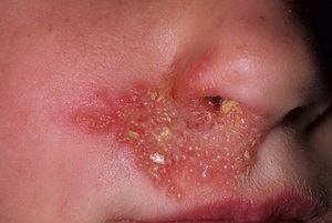 Herpes az arcon a fényképet, okok és a tünetek, kezelési módszerek (fotó) Herpes az arcon fotó, az okok és a tünetek, kezelési módszerek