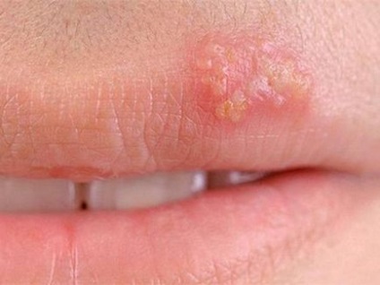 Herpes az arcon a fényképet, okok és a tünetek, kezelési módszerek (herpes arc fotó homlokán) Herpes az arcon fotó, az okok és a tünetek, kezelési módszerek