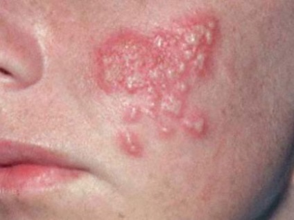 Herpes az arcon a fényképet, okok és a tünetek, kezelési módszerek (fotó) Herpes az arcon fotó, az okok és a tünetek, kezelési módszerek