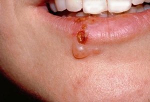 Herpes az arcon fotó, az okok és a tünetek, kezelési módszerek