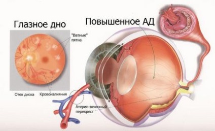 Hipertensivi tipuri de angiopatie retiniană, simptome și tratament