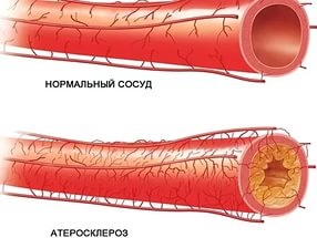 Hirudoterapia în cardiologie 1