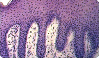 Imagistica histologică a psoriazisului - examen histologic - psoriazis în Rusia