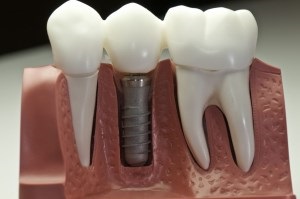 Implantarea prețurilor dinților, prețului, implantării dinților în Togliatti prin metode moderne, implanturi dentare