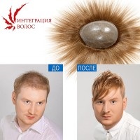 Інтеграція волосся - волосяний чоловічий імплант - 10%