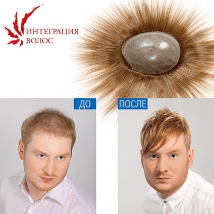 Інтеграція волосся - готові волосяні імпланти