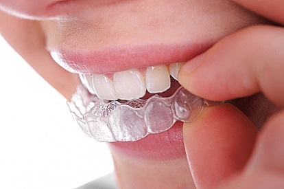 Corectarea ocluziunii de către kappa invizibilă sau acolade fără brațe, selector ortodontist dentar olga