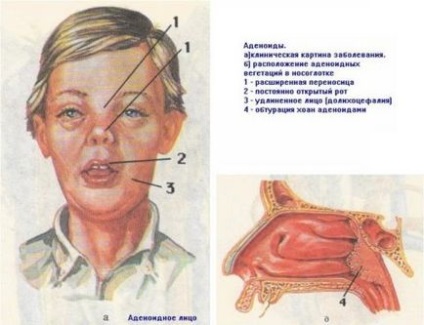 Як лікуються аденоїди у дітей етапи терапії, горлор