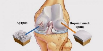 Hogyan kell kezelni gonarthrosis az otthoni